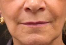 Hyaluronic Acid Before
